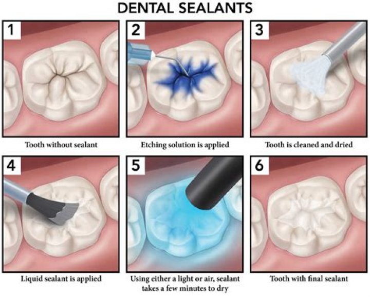 Are sealants necessary