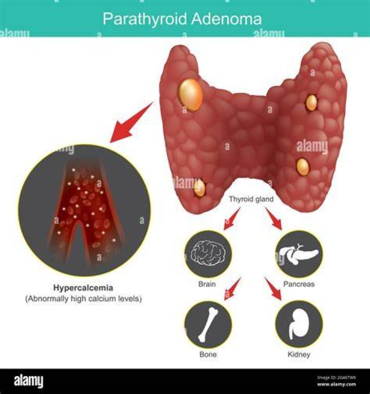 How is parathyroid adenoma different from hyperplasia