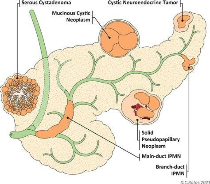 Should I worry about a cyst on my pancreas