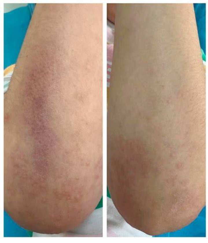 What causes mucinosis
