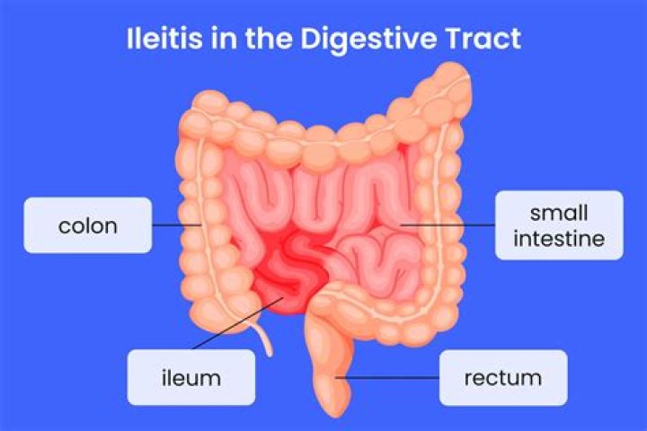 What does terminal ileitis mean