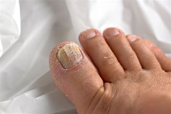 What happens if a nail goes in your foot