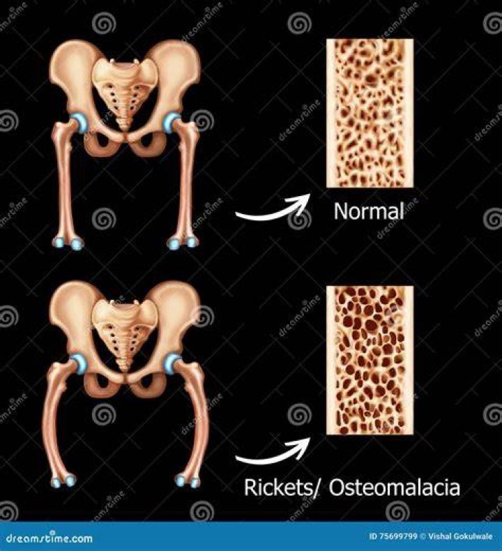 What happens when you have osteomalacia