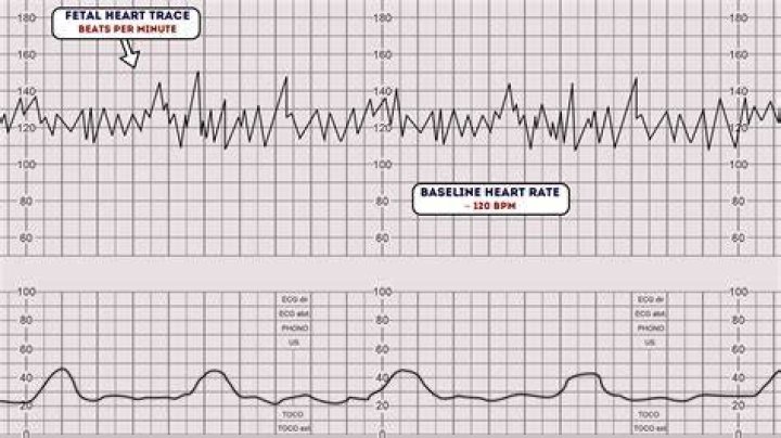 What is a normal baseline fetal heart rate