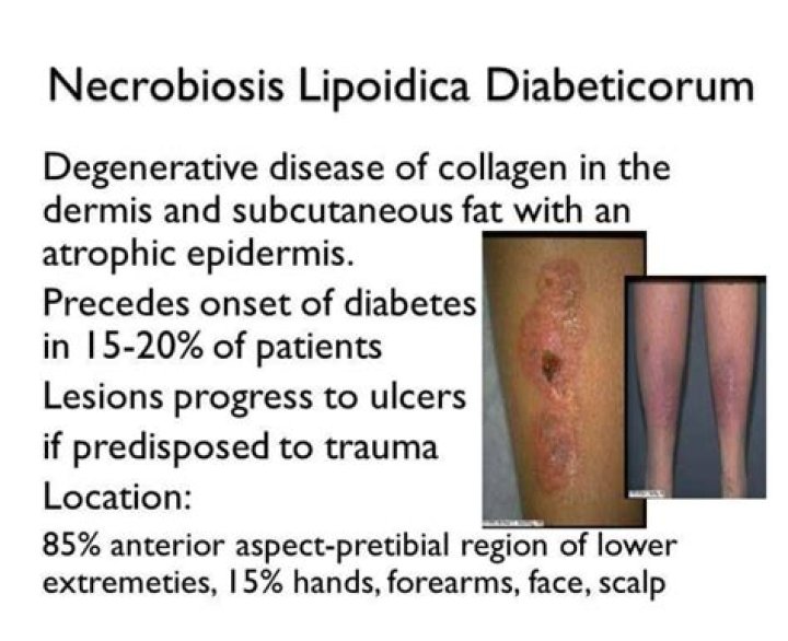 What is Necrobiosis Diabeticorum