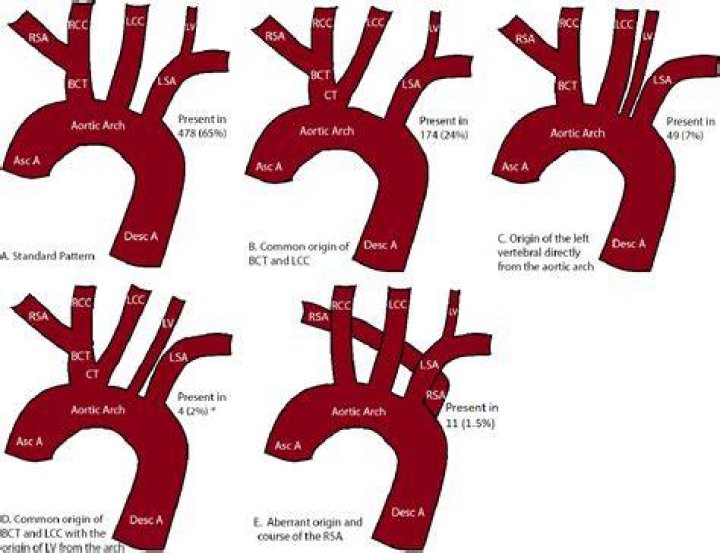 What is the most common anatomic variant of the aortic arch