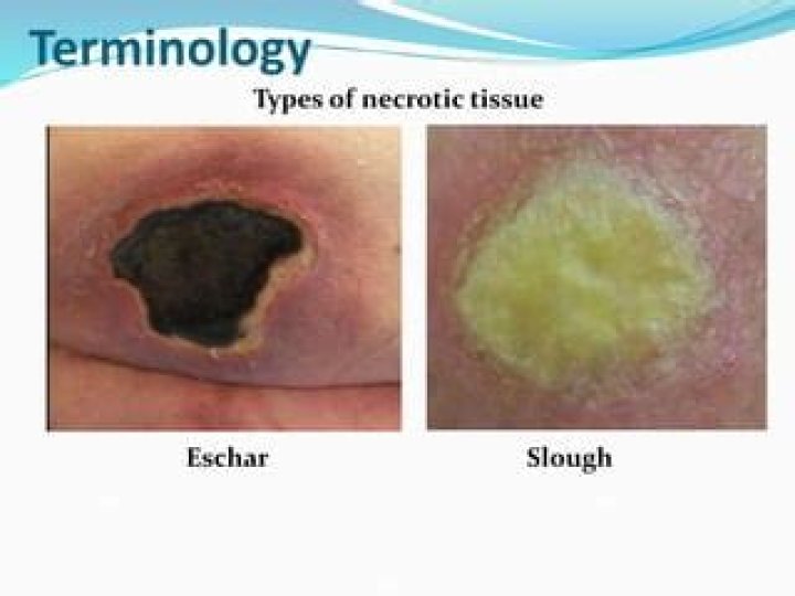 What is tissue Eschar